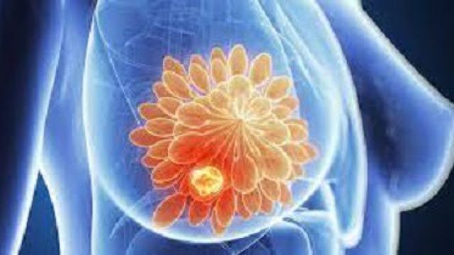 Breast-cancer.jpg